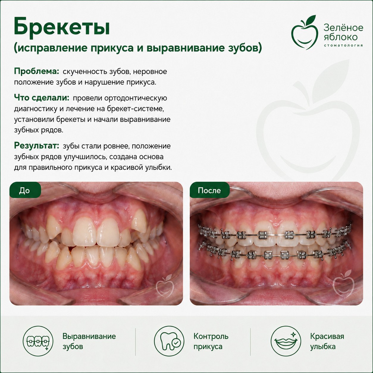 Брекеты: до и после лечения