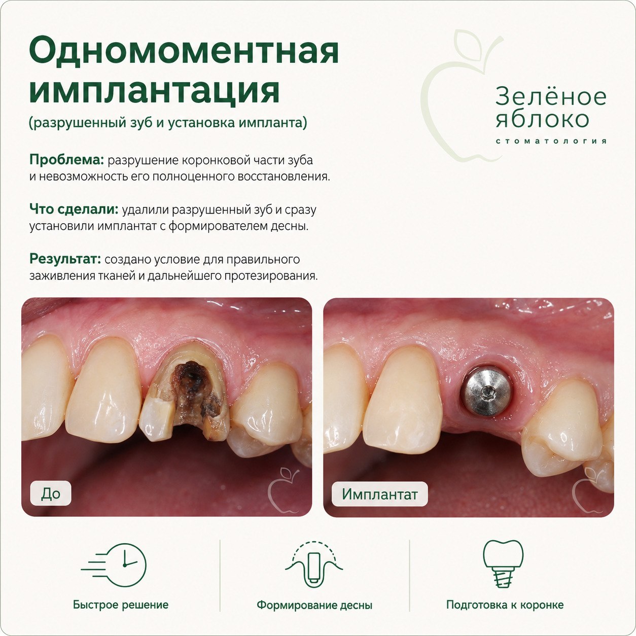 Одномоментная имплантация: клинический случай